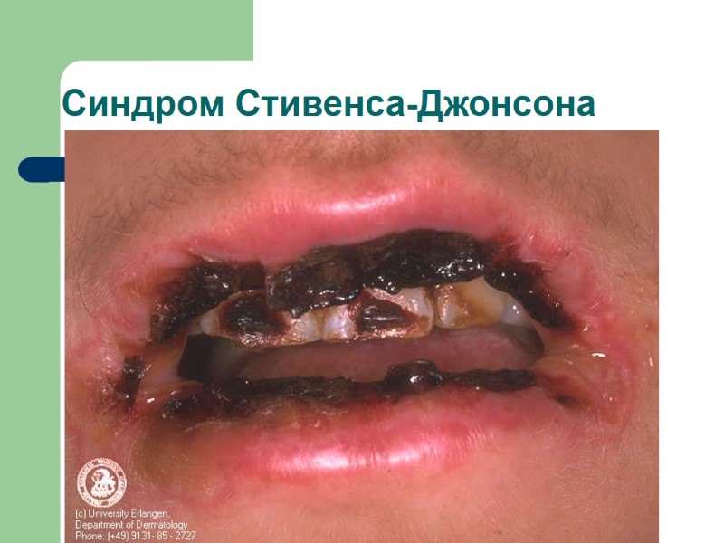 Синдром Стивенса-Джонсона